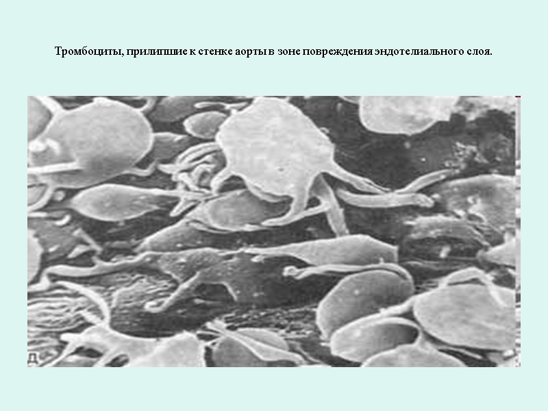 Тромбоциты, прилипшие к стенке аорты в зоне повреждения эндотелиального слоя.